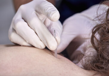 How Does Dry Needling Work?