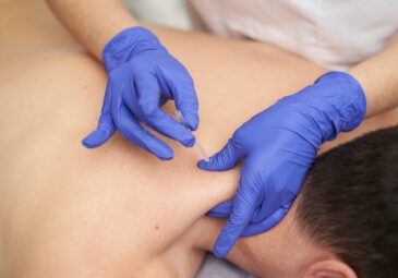 What Is Dry Needling and How Does It Work?