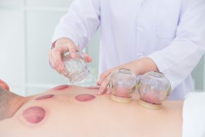 Man receiving cupping procedure for Chiropractic Cupping Crown Point.