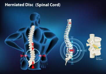 Signs and Symptoms that May Indicate a Herniated Disc