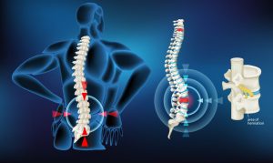 Herniated disc for spinal health see our chiropractor for Chronic Pain Treatment St. John.