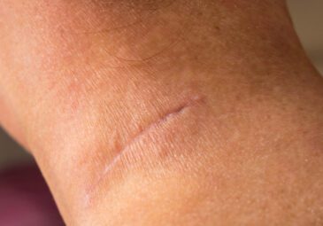 Natural Ways to Treat Scar Tissue